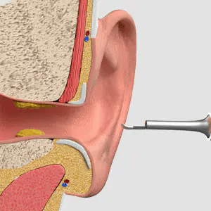 WaxClean® - Pulizia Intelligente delle Orecchie con Tecnologia Avanzata